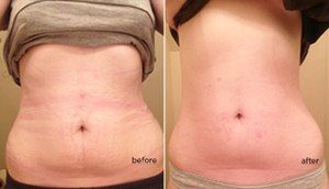 Read more about the article Waist Training Before and After Story – Sarah Tisdale
